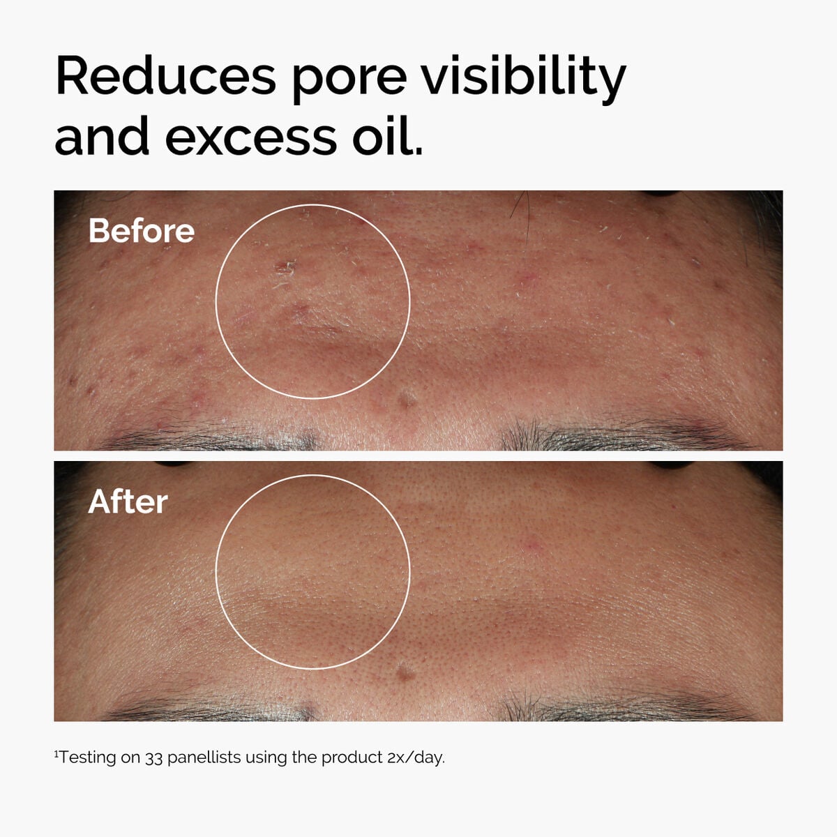 niacinamide-10-zinc-1-q5 ord-niacinamide-zinc-blemish-serum-before-after-pores.jpg