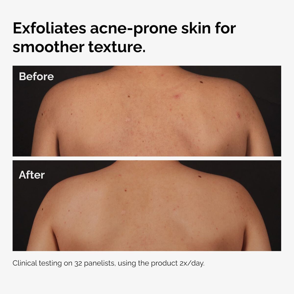 salicylic-acid-0-5-body-serum-k8 ord-salicylic-acid-body-serum-before-after-graphic-NA.jpg