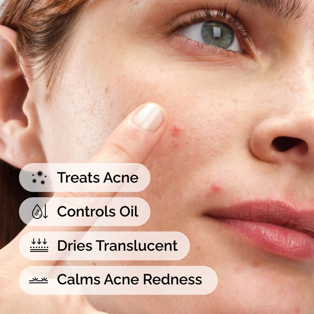 sulfur-10-powder-to-cream-concentrate-r5 ord-sulfur-10pct-powder-to-cream-concentrate-model-application-with-benefits-acne.jpg
