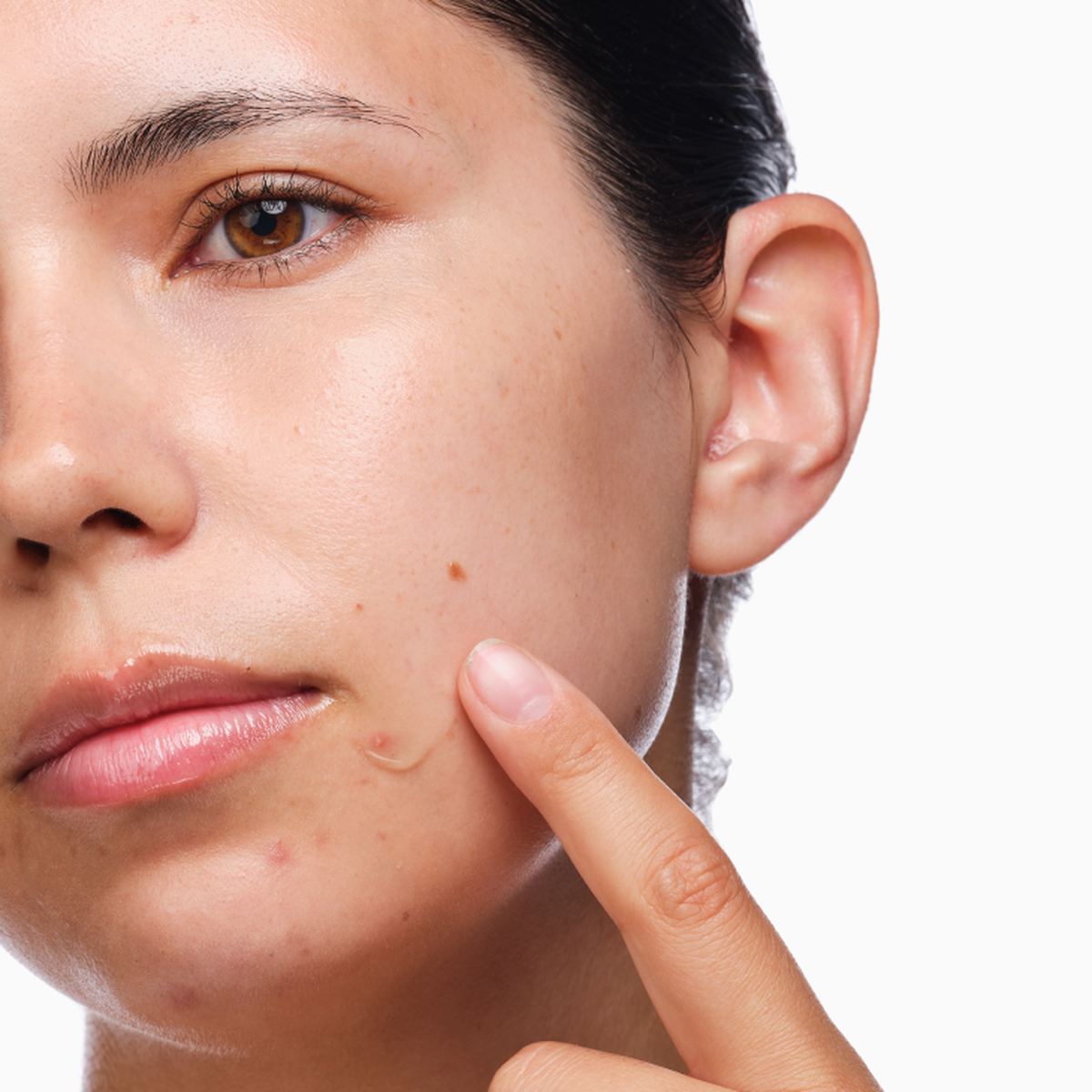 the-acne-set-i4 rdn-the-acne-set-application.png